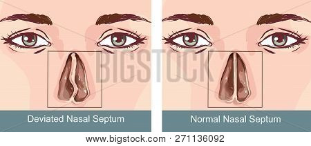 Vector Illustration Of A Nasal Septum Deviation Treatmen