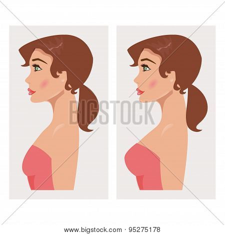 Chest Before And After Plastic. Vector Illustration