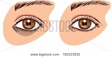 The woman's face with dark circles under the eyes. The concept of care for eye skin. before and after