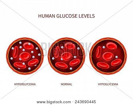 Human Glucose Levels Hyperglycemia, Normal, Hypoglycemia. Hematology Vector Diagram With Blood Vesse