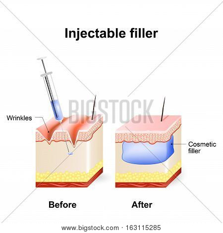 injectable cosmetic filler. How it works. Procedure. Before and after injection.