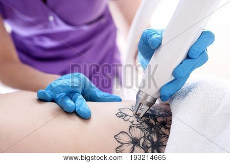 Laser tattoo removal in cosmetic surgery.Laser tattoo removal in the clinic of aesthetic medicine.