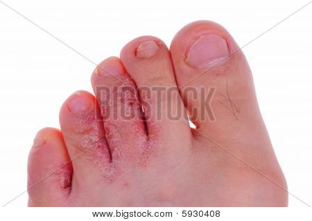 athlete's foot