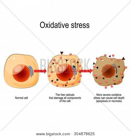 Oxidative Stress. From Normal Cell, To Oxidative Stress And Aggressive Free Radicals, Cell Death. Ve