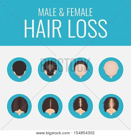 Male and female pattern hair loss set. Stages of baldness in men and women. Alopecia infographic medical design template. Hair loss clinic concept design. Vector illustration.