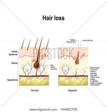 Hair loss. Normal hair and Alopecia areata in the human skin. alopecia or baldness. Vector illustration