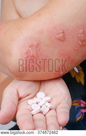 Shingles, Zoster Or Herpes Zoster Symptoms With Antiviral Drug