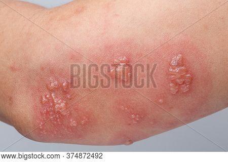 Shingles, Zoster Or Herpes Zoster Symptoms On Arm