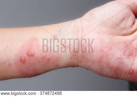 Shingles, Zoster Or Herpes Zoster Symptoms On Arm