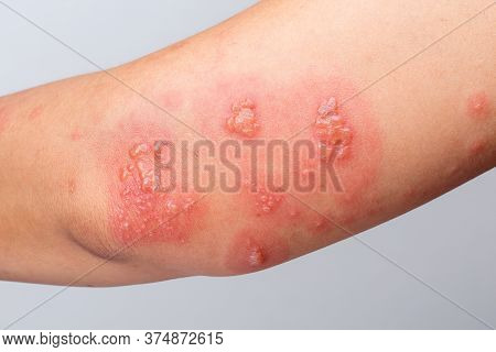 Shingles, Zoster Or Herpes Zoster Symptoms On Arm