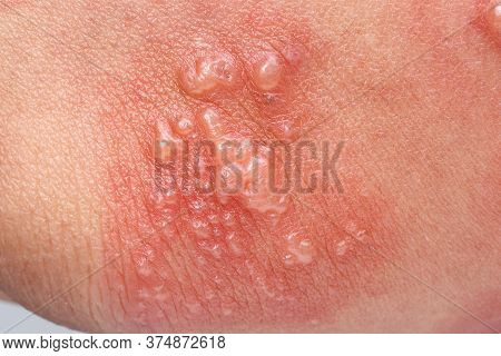 Shingles, Zoster Or Herpes Zoster Symptoms On Arm