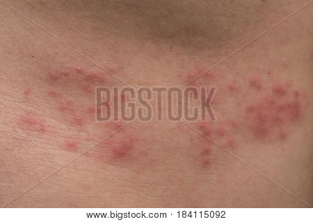 Closeup of body skin with Herpes Zoster (Shingles)