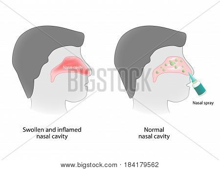 inflammation of the nasal cavity and nasal cavity healthy. Nasal spray. Human anatomy