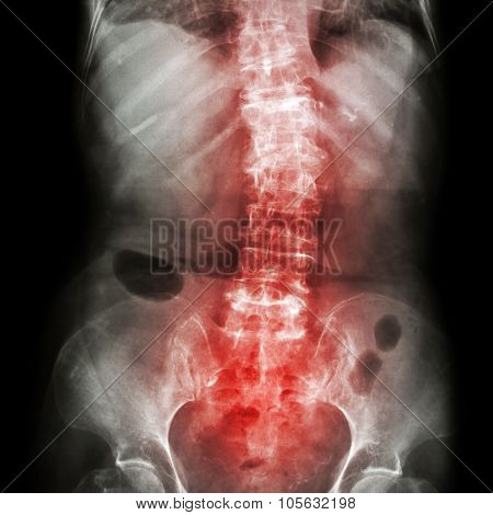 Spondylosis And Scoliosis