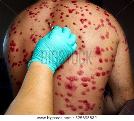 Skin Rash Treatment On Male Body. Shingles, Disease, Herpes Zoster, Varicella-zoster Virus. Skin Ras