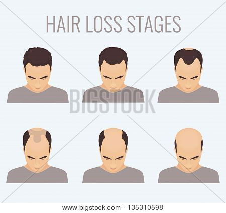 Male hair loss stages set. Top view portrait of a man losing hair. Male pattern baldness. Transplantation of hair. Signs of balding. Frontal hair loss. Vector illustration.