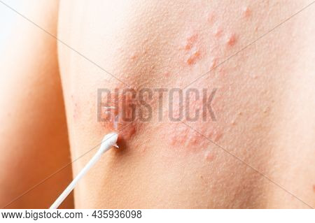 Cotton Swab Treatment Of Skin Rash. Shingles, Varicella-zoster Virus. Skin Rash And Blisters On Body