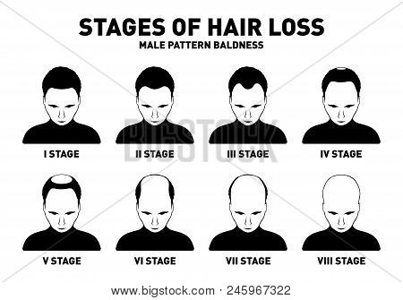 Hair Loss. Stages And Types Of Male Hair Loss. Male Pattern Baldness. Head Of Hairy And Bald Man In 