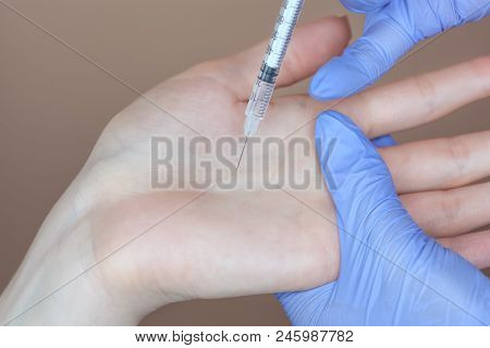 The Doctor Makes Intramuscular Injections Of Botulinum Toxin In The Underarm Area Against Hyperhidro