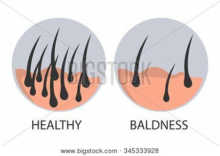 Hair Loss Stages Set Of Before And After Steps. Side View Of A Man Losing Hair Before And After Hair