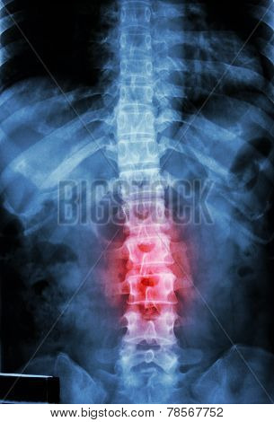 inflammation at lumbar spine