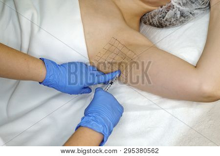 Hands Of Cosmetologist Are Close-ups Injecting Hyaluronic Acid Into Armpit Area Of Girl. Treatment O