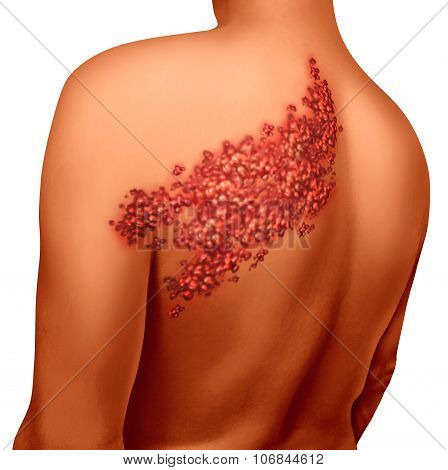 Shingles Disease