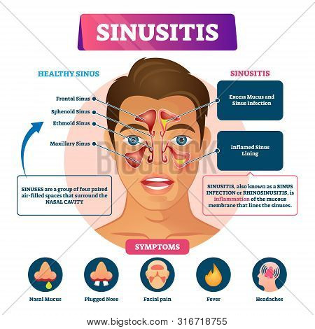 Sinusitis Vector Illustration. Labeled Rhinosinusitis Inflammation Scheme. Anatomical Explanation Wi