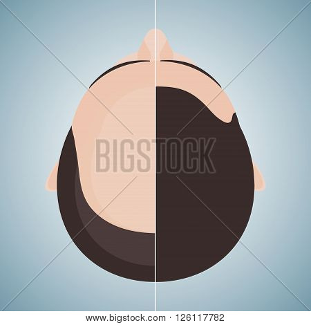 Top view portrait of a man before and after hair treatment and hair transplantation. Divided image of a head. Two halves. Hair care concept. Isolated vector illustration.