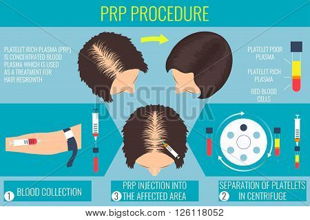 Platelet rich plasma injection. PRP therapy process. Male hair loss treatment infographics. Injection. Meso therapy. Hair growth stimulatio. Vector illustration.