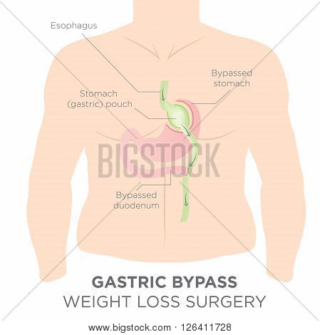 Gastric Bypass for Weight Loss - You Are Actually Re-routing Your Stomach in Order to Feel Full and Eat Less