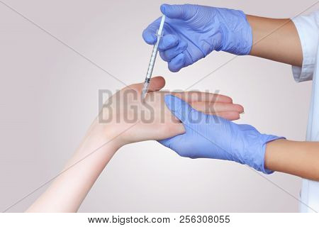 The Doctor Makes Intramuscular Injections Of Botulinum Toxinon The Palms Of A Woman Against Hyperhid