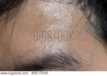 Excessive Sweating Or Hyperhidrosis And Oily Skin At Forehead Of Southeast Asian, Myanmar Or Chinese