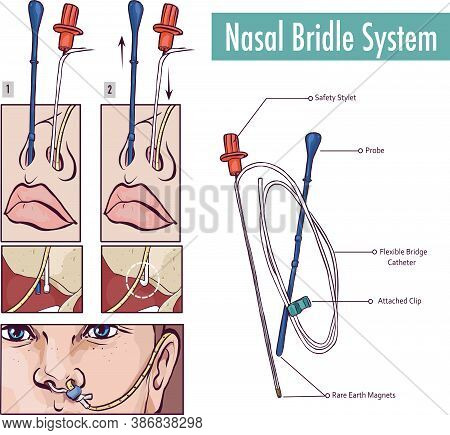 A Nasal Bridle Attaching A Nasogastric Tube To The Nasal Septum To Prevent Accidental Pullout