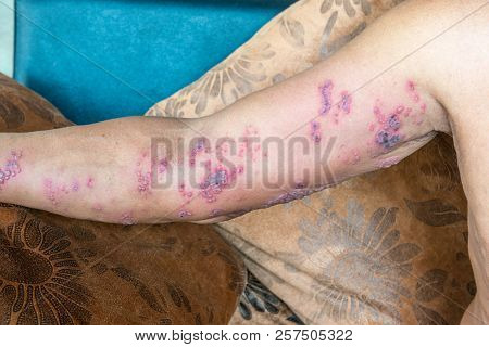 Symptom Of Herpes Zoster Virus On Arm . Skin Infected Herpes Zoster Virus.