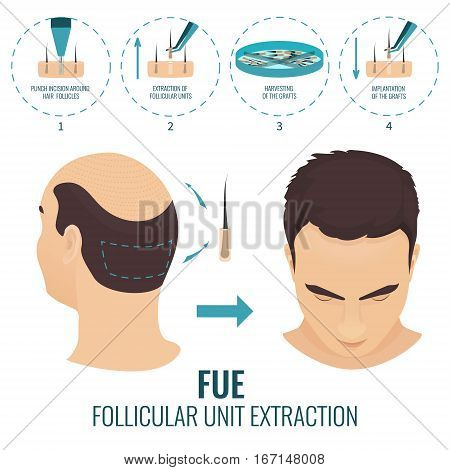 Male hair loss treatment with follicular unit extraction. Stages of FUE procedure. Alopecia infographic medical design template for transplantation clinics and diagnostic centers. Vector illustration.