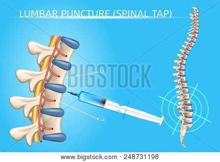 Lumbar Puncture Or Spinal Tap Procedure Medical Vector Poster With Human Vertebral Column And Syring