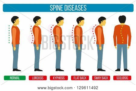 Body posture defect. Vector infographics of spine diseases. Scoliosis and lordosis medical diagrams. Spine backbone, spine diagnosis, diagnostic spine symptom, design spine diseases illustration