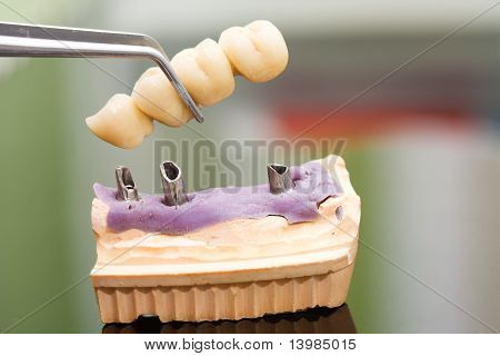 Dental Implant Head And Bridge