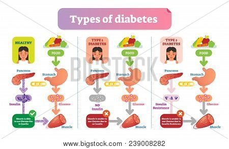 Types Of Diabetes Simple Medical Vector Illustration Scheme. Health Care Information Diagram With Ty