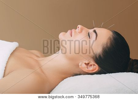 Beautiful Woman Has A Headache. Acupuncture Treatment For Migraines. Needles In The Forehead Of A Wo