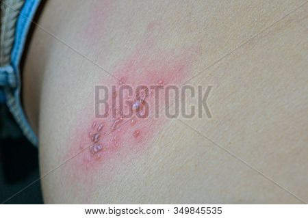 Raised Red Bumps And Blisters Caused By Shingles On Skin, Herpes Zoster.