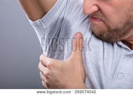 Man With Hyperhidrosis Sweating Very Badly Under Armpit