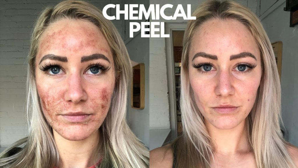 chemical peel Malaysia- stellar clinic