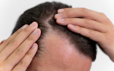 Does Stem Cell Hair Restoration Work?