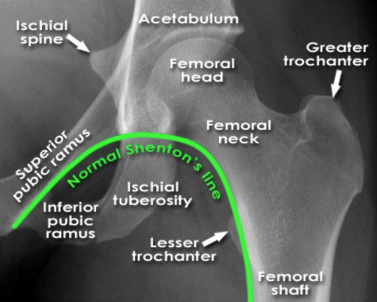 Managing Dislocations of the Hip in the ED – St. Joseph's Health Center ...