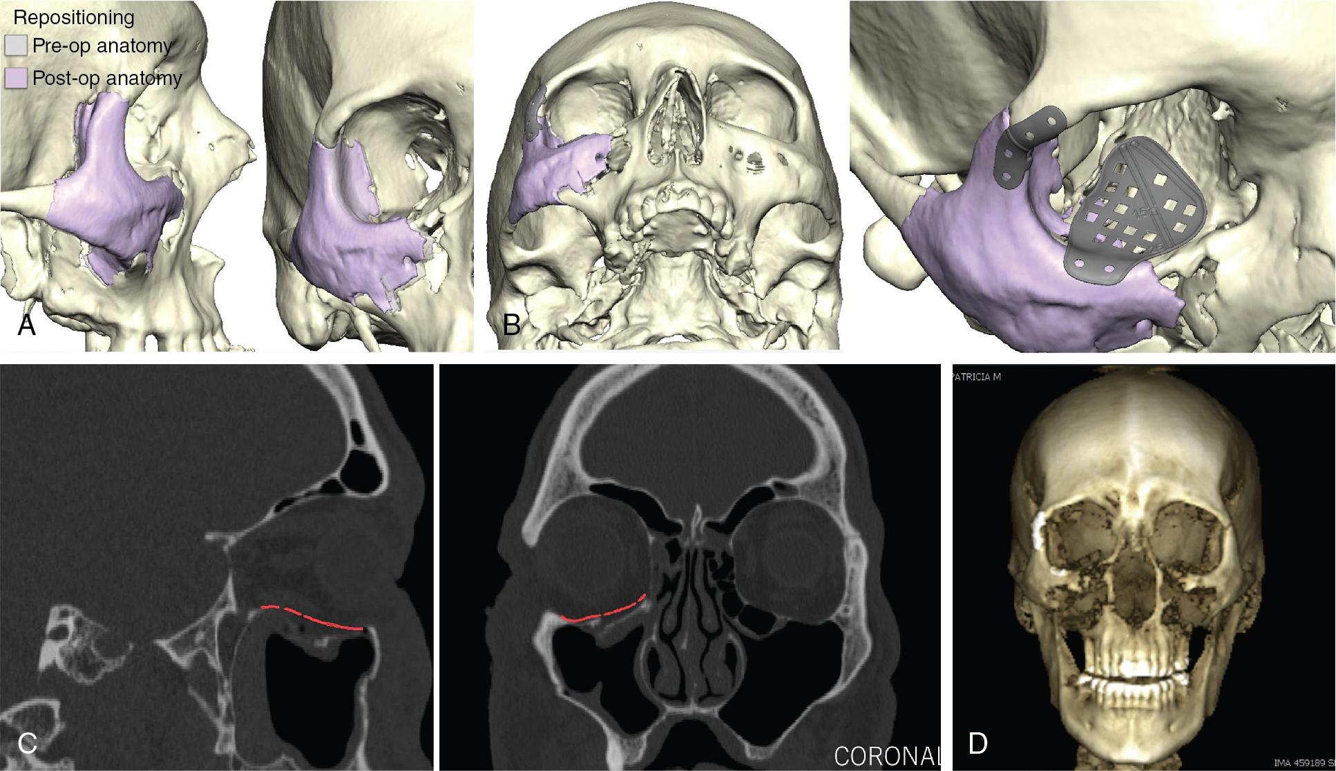 Computer-assisted surgical planning in craniomaxillofacial trauma ...