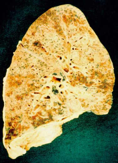 Environmental- and Toxin-Induced Lung Diseases - Clinical Tree