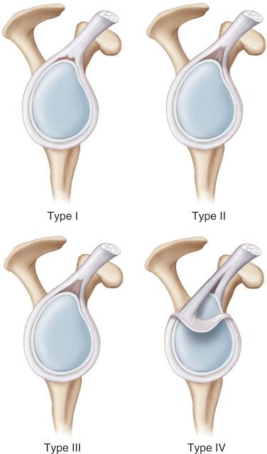 Failed SLAP Tear: Diagnosis and Management - Clinical Tree