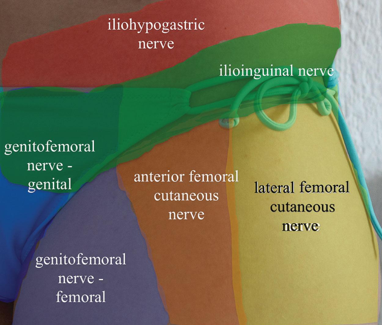 Figure 17.1, Pain patterns from iliohypogastric, ilioinguinal, genitofemoral, lateral femoral cutaneous, and anterior femoral cutaneous nerves.